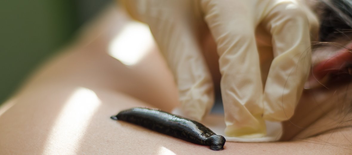 Hirudoterapie funguje. Účinnost léčby pijavicemi je vědecky prokázána.