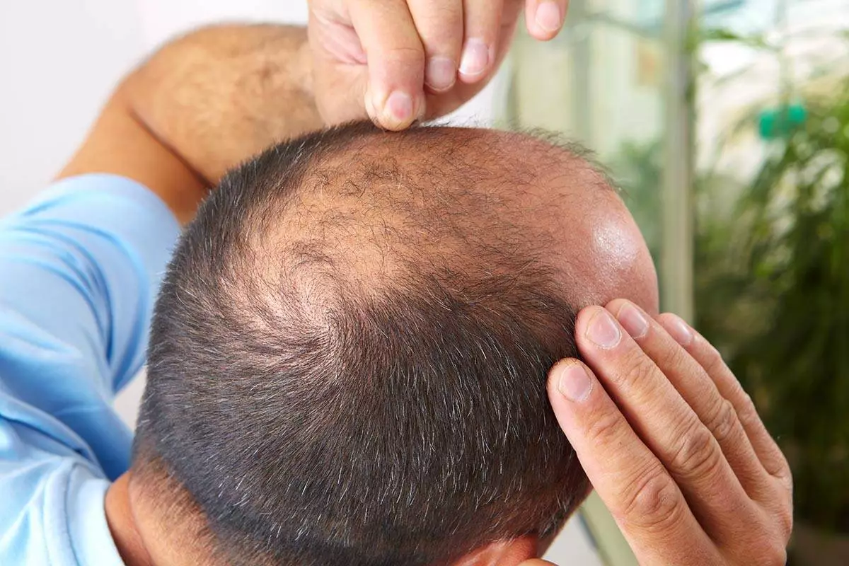 V roce 2024 si vědci stanovili za cíl vyvinout definitivní lék: podařilo se jim vytvořit nový prostředek proti alopecii.