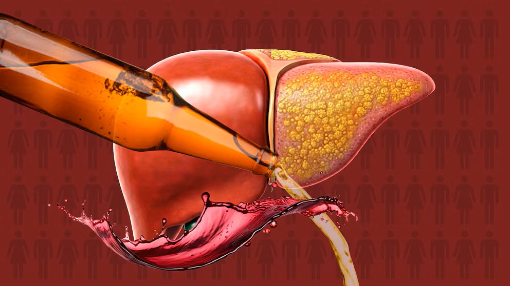 Kolik piva nebo sklenic vína zvyšuje riziko vzniku tukové dystrofie jater: rozdíly mezi muži a ženami