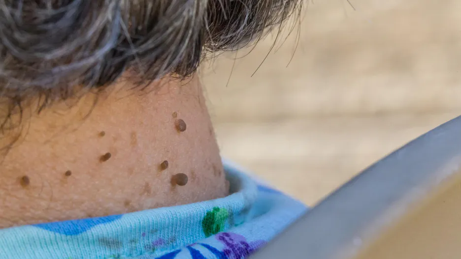 Máte fibromy na krku? Vědci objevili určitou zákonitost