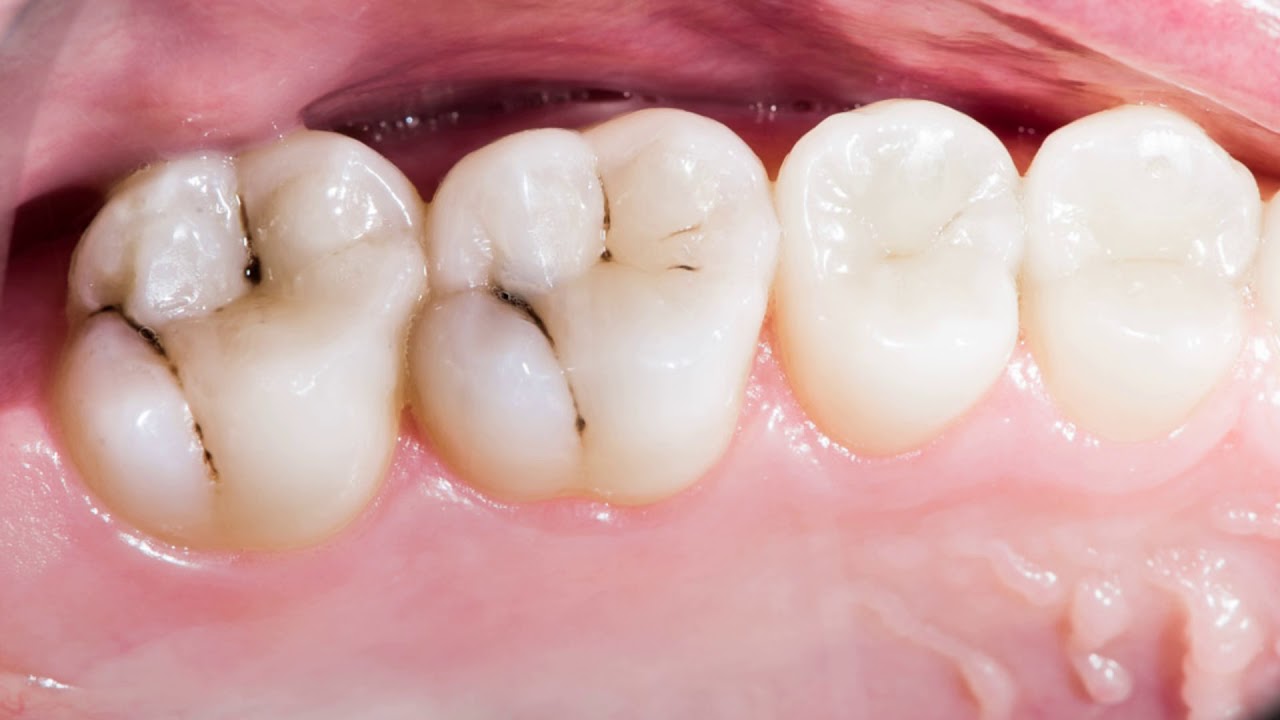 Sbohem, zubní kaz? Vědci našli způsob, jak obnovit zubní sklovinu.