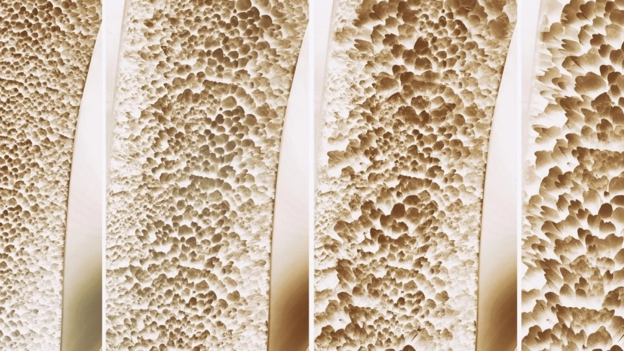 Nový průlom v posilování kostí může zvrátit osteoporózu