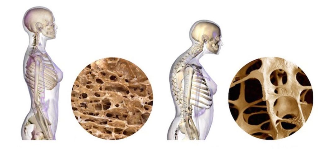Nový průlom v posilování kostí může zvrátit osteoporózu